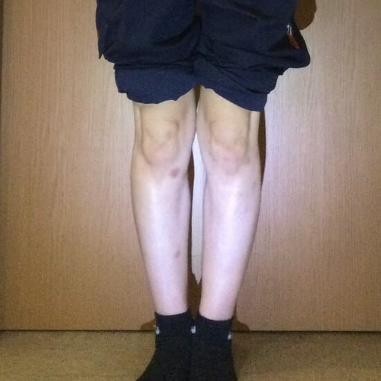 30代女性O脚矯正アフター