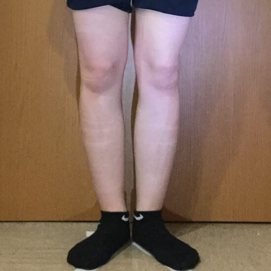 20代女性O脚矯正アフター１