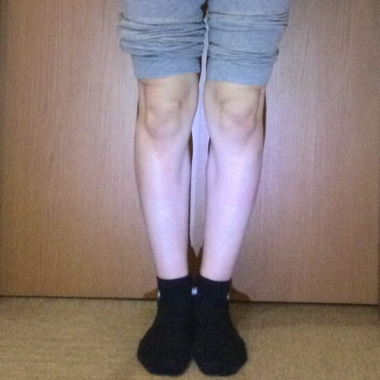 30代女性O脚矯正ビフォアー