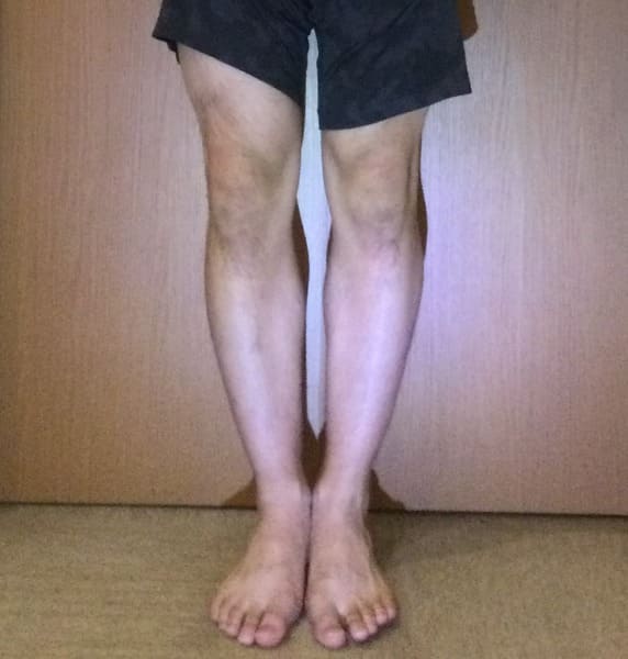 18歳男性O脚矯正アフター