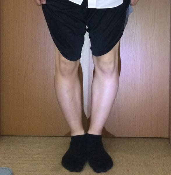 18歳男性O脚矯正ビフォアー