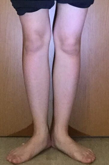 20代女性O脚矯正アフター