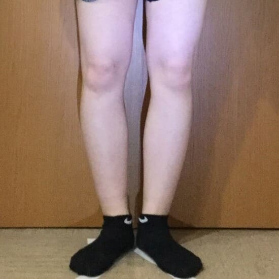 20代女性O脚矯正ビフォアー１