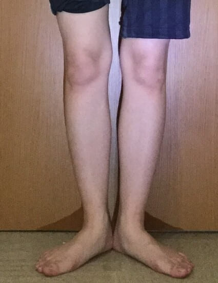 20代女性O脚矯正ビフォアー