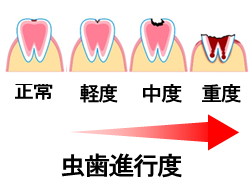 虫歯進行度