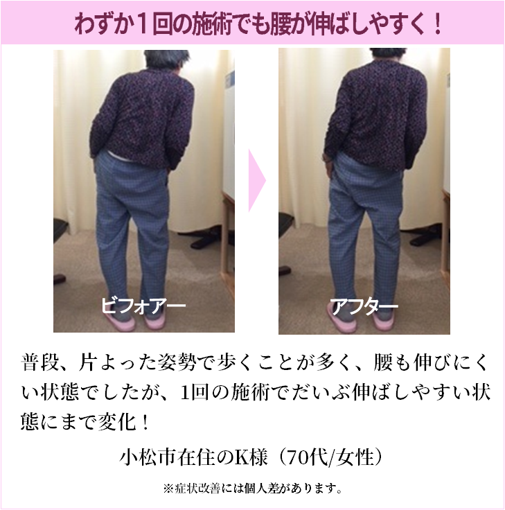 普段、片よった姿勢で歩くことが多く、腰も伸びにくい状態でしたが、1回の施術でだいぶ伸ばしやすい状態にまで変化！
小松市在住のK様（70代/女性）
※症状改善には個人差があります。