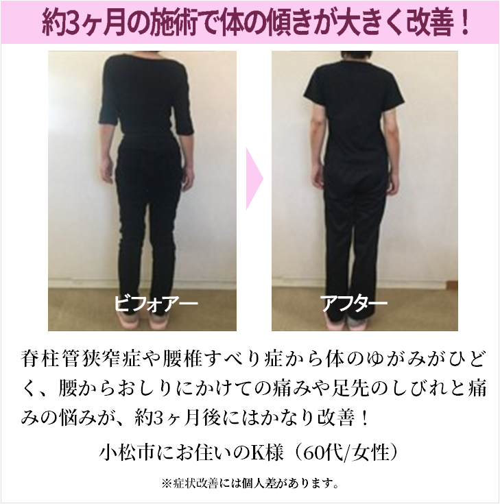 脊柱管狭窄症や腰椎すべり症から体のゆがみがひどく、腰からおしりにかけての痛みや足先のしびれと痛みの悩みが、約3ヶ月後にはかなり改善！
小松市にお住いのK様（60代/女性）
※症状改善には個人差があります。