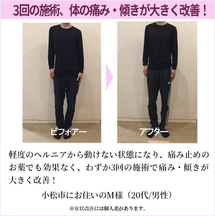 軽度のヘルニアから動けない状態になり、痛み止めのお薬でも効果なく、わずか3回の施術で痛み・傾きが大きく改善！
小松市にお住いのM様（20代/男性）
※症状改善には個人差があります。